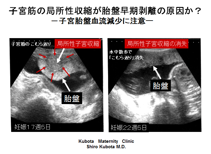 妊娠 チクチク