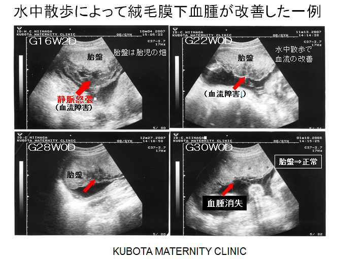 チクチク 妊娠後期 お腹 妊娠初期の右下腹部痛でチクチク・ズキズキ…心配なのはどんな時？